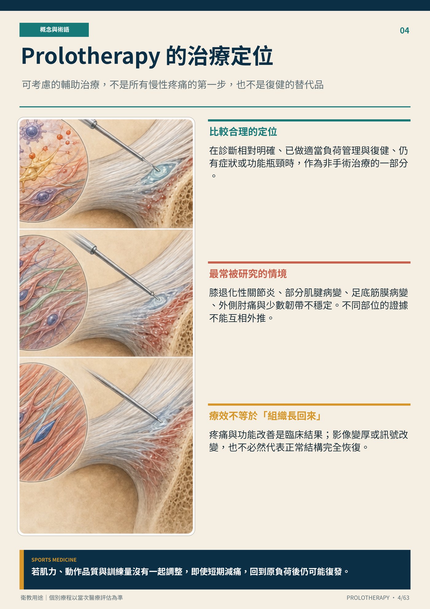Prolotherapy 的治療定位｜衛教資訊圖